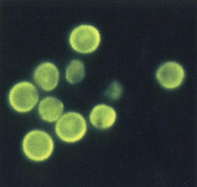 Pneumocystis Pneumocystis jiroveci hela världen, fra norra halvklotet luftburen i miljön, smitta person-person 5 15 % av allo HSCT resp SOT utan profylax interstitiell pneumoni torrhosta, hypoxi