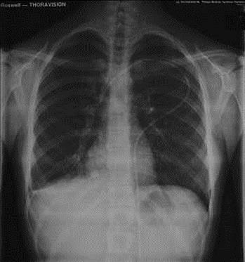 Diagnostik Nukleinsyrepåvisning PCR Pneumocystis jirovecii-pcr Luftvägar Sens BAL ca 100 %. NPV 100%. Låg specificitet. Kvantitativt PCR? Generell svamp-pcr 18S (rrna-gen) Låg sens.