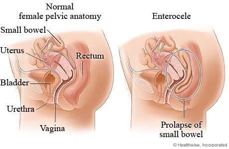 Enterocele Etiologi 1: Anatomisk variant?