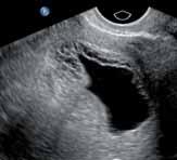 PLACENTA FAKTARUTA Placenta previa och dess komplikationer - Risken för placenta previa ökar med stigande ålder och tidigare uteruskirurgi.