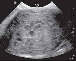 Stora lakuner är ett tidigt tecken på placenta accreta.