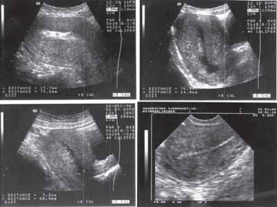 Transabdominal ultraljudsbild av 3 standardsnitt av uterus i tidigt puerperium; sagittalt snitt (a), choronart snitt (b), och transversellt snitt (c).