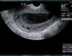 Transvaginala ultraljudsbilder av puerperala komplikationer: placentarest 5 veckor postpartum (a), ett starkt blodflöde med färg Doppler syns i anslutning till placentarester (b).