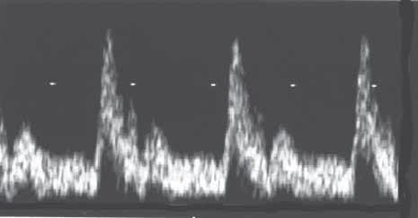 MEDICINSK ULTRALJUDSDIAGNOSTIK Figur 5 Figur 6 Hastighetsprofil Blodkärl Hastighet (cm/s) tid (s) Hastighetsprofilen över kärlets tvärsnittsarea återspeglas i frekvens/hastighetsspektret som Doppler