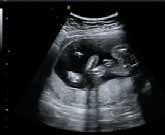 INVASIVA INGREPP UNDER GRAVIDITET. FOSTERVATTEN- OCH MODERKAKSPROV. Bild 1 Bild 2 Abdominellt fostervattenprov, amniocentes. Insticket sker via bukväggen till amnionhålan.
