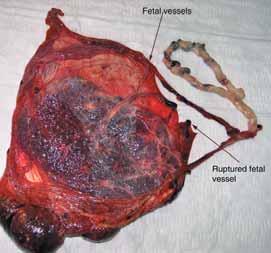 PELLE LINDQVIST Vasa previa En sällsynt men potentiellt allvarlig fetal komplikation är föreliggande fetala kärl.
