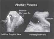 Den viktigaste riskfaktorn för vasa previa är låg placentation i andra trimestern (placenta < 1 cm från inre modermunnen i graviditetsvecka 20).