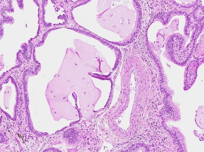 kolumnen) Inte UIP mönster ( Not UIP pattern ), något av de sex kriterierna Hyalina membraner Organiserande pneumoni Granulom Tydlig