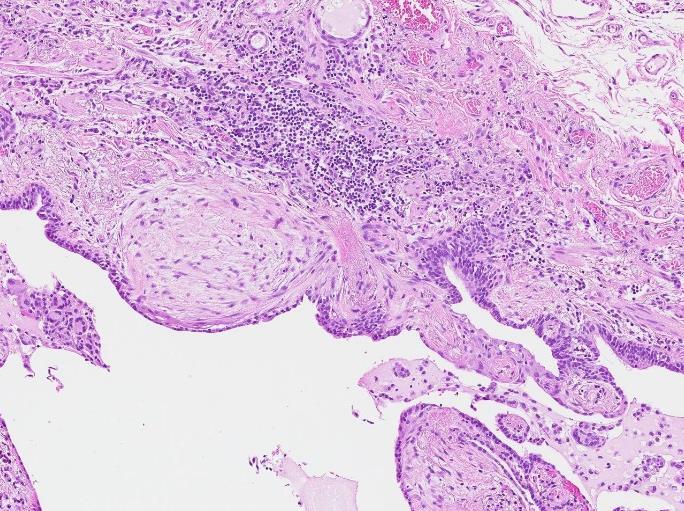 Fibroblastfoci samt kronisk inflammation i fibros och bronkialisering vid UIP. Non-specific interstitial pneumonia (NSIP) NSIP delas upp i fibrotisk och cellulär variant.