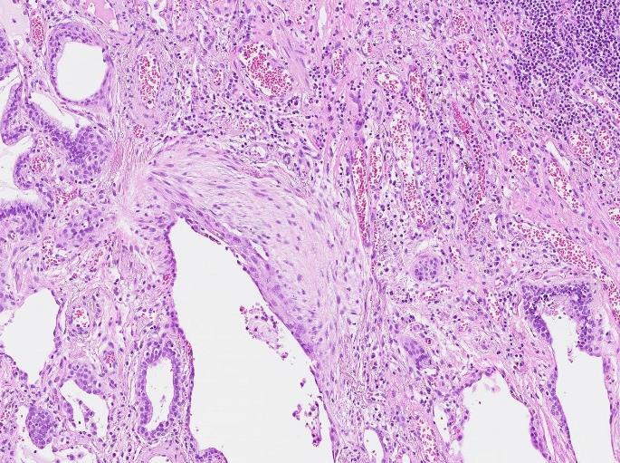 Ett lätt inslag av makrofager ses ibland, medan granulom, akut inflammation och fibroblastfoci inte ska förekomma. Båda typer kan även ses icke-idiopatiskt vid t.ex.