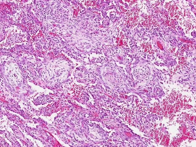 Organiserande pneumoni. Diffuse alveolar damage (DAD) / Akut interstitiell pneumoni (AIP) Vid DAD beror histopatologisk bild på när i förloppet lungvävnaden undersöks.