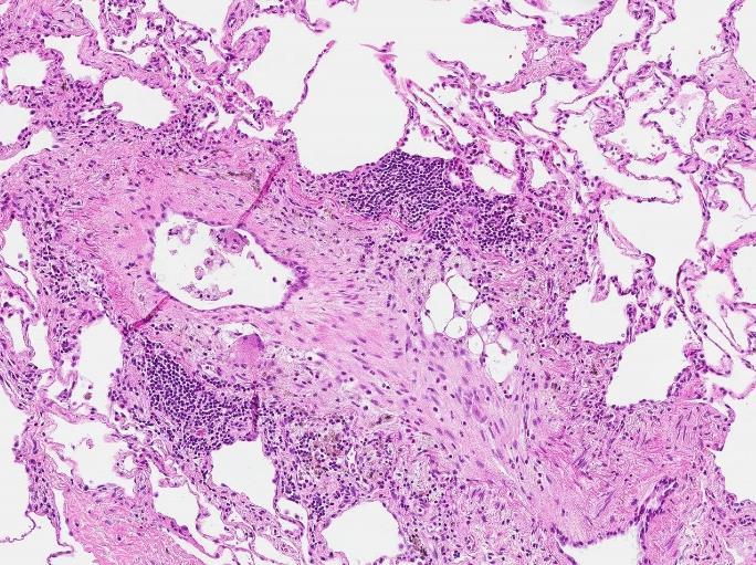 Kliniskt/radiologiskt finns andra definitioner (liten förkalkad rundad förändring på CT kallas granulom, men brukar histologiskt motsvara oregelbunden eller nodulär fibros med förkalkning och bero på