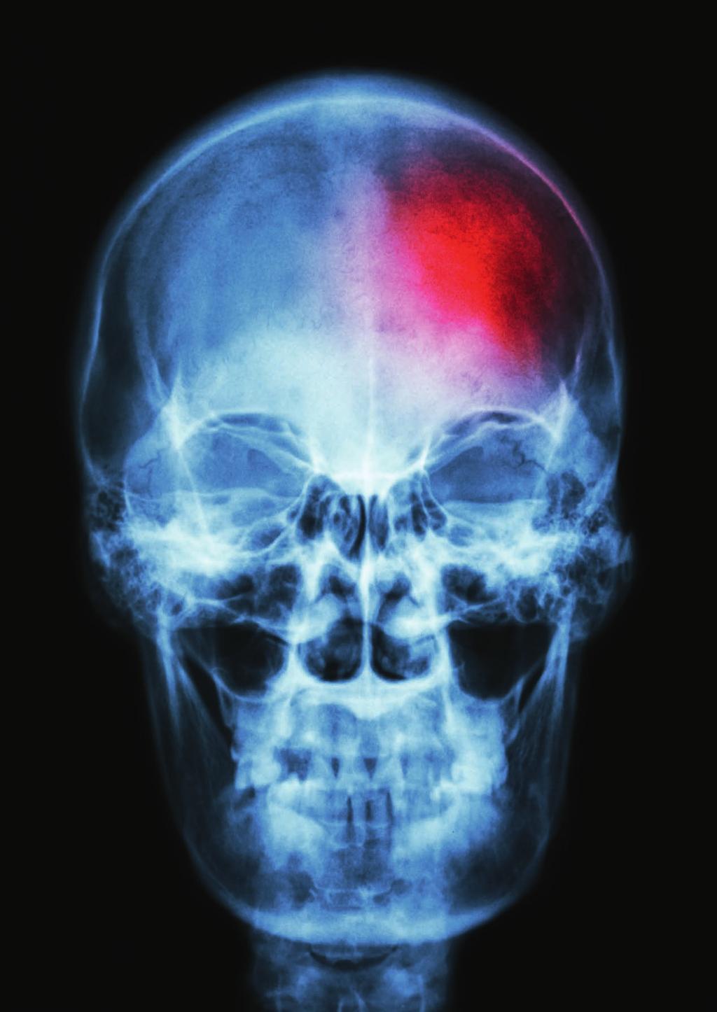 64 neurologi i