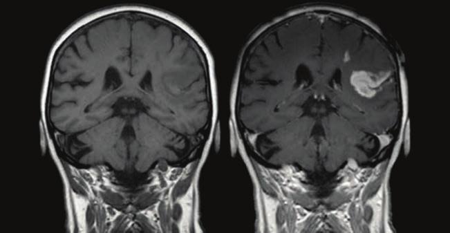A Extracellulär matrix Astrocytutskott Neuron Substratet för tpa i dess funktion att reglera blodhjärnbarriären är platelet-derived growth factor, subtyp CC (PDGF-CC) Pericyt Aktiverad PDGF-CC