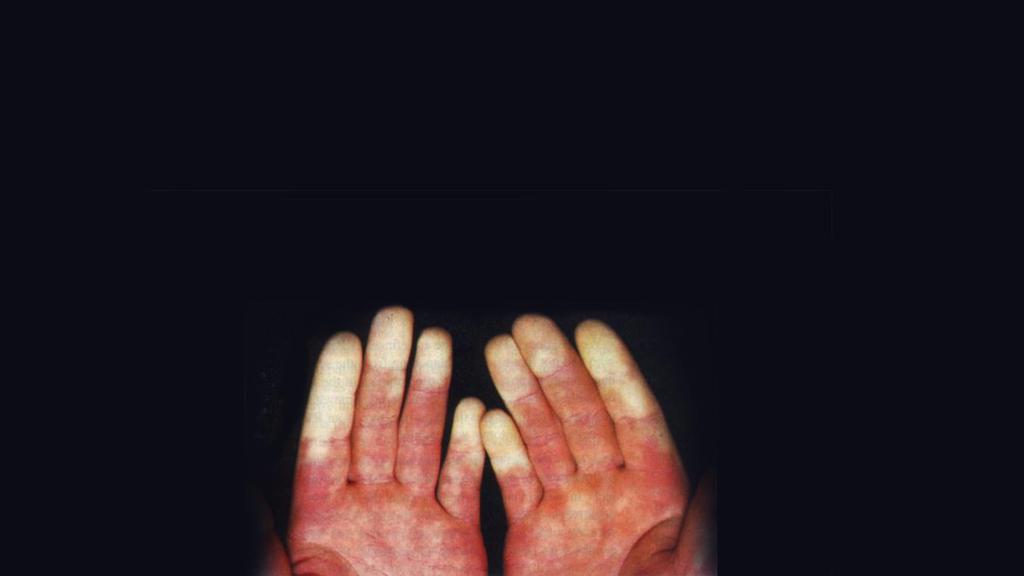Zero vibration injuries Vibration damage is the second most common cause of occupational