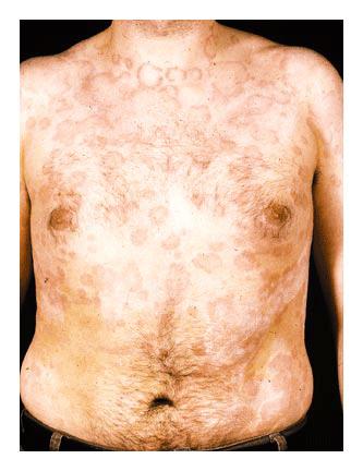 Typ B / Immunologi Ampicillinutlöst