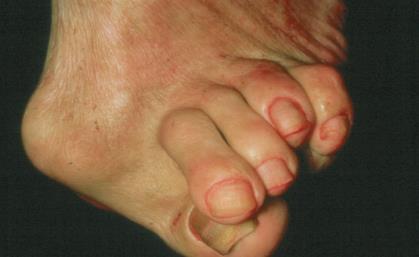 Grav hallux valgus -