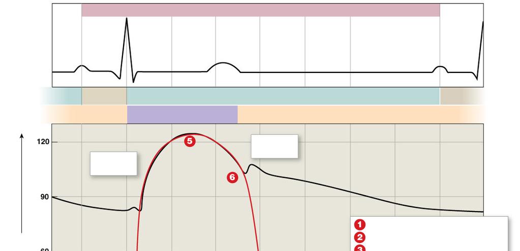 10.På nedanstående bild finns tre grafer, den översta som visar EKG, den mellersta bilden som visar på tryckförändringar i vänsterkammare=rött, aorta=svart och i