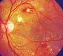 Screening för komplikationer Ögon: ögonbotten-fotografering Njurfunktion: blod- och urinprov (tidigt tecken albuminläckage) Nerver: