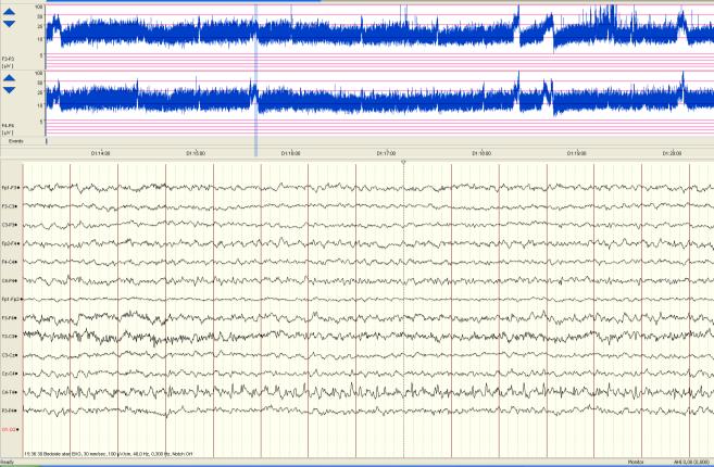 EEG-monitorering Kontinuerlig EEG (ceeg, CFM)- övervakning av hjärnfunktion hos