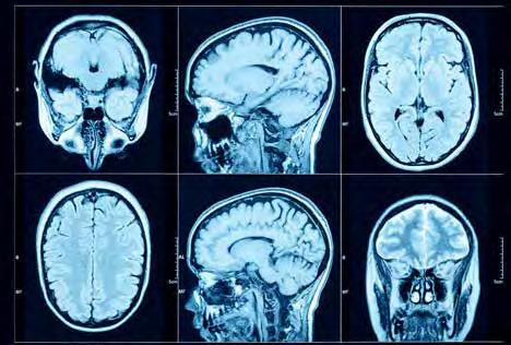 ASCO Negativa fas 3-studier vid hjärntumörer I mars insjuknade min patient i ett epileptiskt anfall, och man fann att det orsakats av en hjärntumör som opererades några veckor senare.