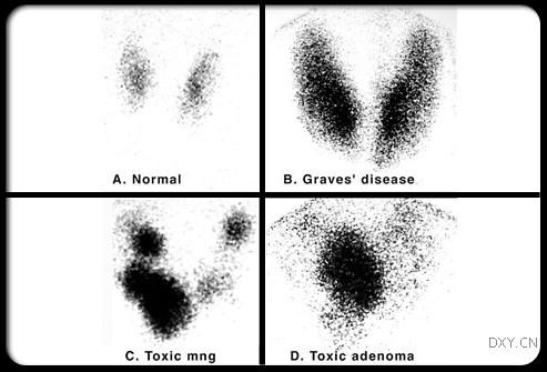 Diagnostik vid hypertyreos TSH, T3/T4 TRAK (antikroppar) finns vid Graves sjukdom Ultraljudsledd