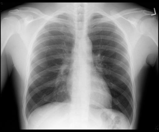 Lungröntgen Säger inget om hjärtfunktionen Har låg sensitivitet och specificitet Kan visa förstorat hjärta, stas eller pleuravätska hos akut sjuka.