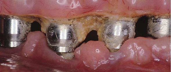 Implantatöverlevnad Figur 1. Ansamling av mikroorganismer runt implantatet är en viktig etiologisk faktor. ologiskt syns ofta en kraterformad destruktion runt implantatet.