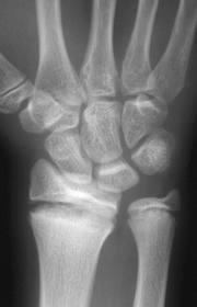 Gymnast s wrist Fys = tillväxtzon Fysen i