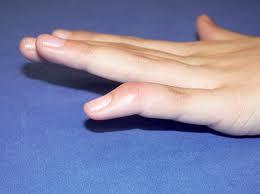 Handstatus Inspektion Hematom, svullnad, felställning Vilotonus i fingrarna Typisk Mallet-finger Skada på extensorsenan