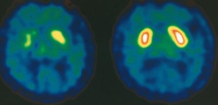 Parkinson Förändringar i hjärnan vid Parkinson Olika sjukdomsfaser Parkinsons sjukdom en sjukdom med gradvis utveckling, olika faser Framför allt en fortlöpande påverkan