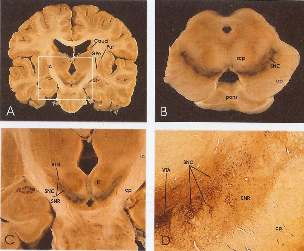 noradrenalinceller (locus coeruleus) Förändringar i hjärnan vid Parkinson Distribution av Lewy
