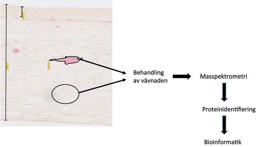 Figur 2. Färgning med kongorött av ett histologiskt snitt av kornea, där amyloidinlagringarna framträder tydligt i en mörkare röd nyans.