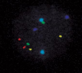 Analysmetod Kromosomavvikelser FISH array CGH Next generation sequencing (NGS) 31 Analysmetod Monogenasjukdomar Kopplingsanalys med ev.