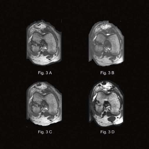 skillnad mellan undersökningarna. (Copyright Jüri Kartus) Fig 2. Bredd och tjocklek mättes i knäskålssenans mittpunkt mellan apex patellae och tuberositas tibiae.