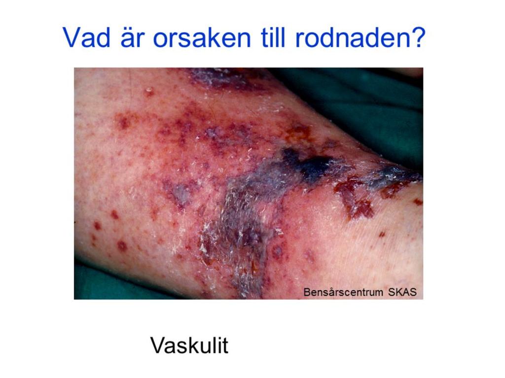 Rodnaden beror på en