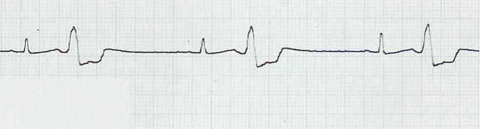 Rita ett fonokardiogram och en pulskurva som uppvisar tecken på en tät aortastenos förklara vad som ger kurvorna dess utseende och ange hur de är registrerade, motivera ditt val