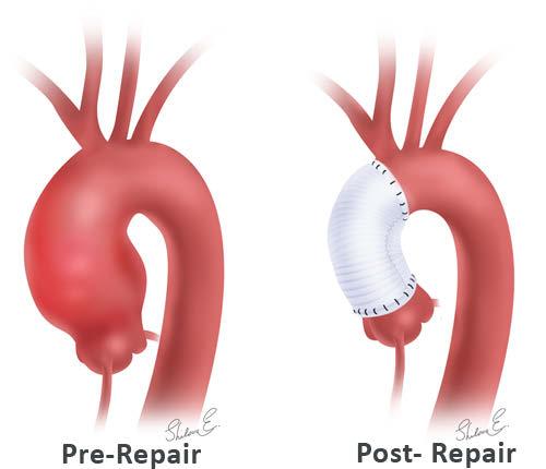 Aortaroten och aorta ascendens Aneurysm