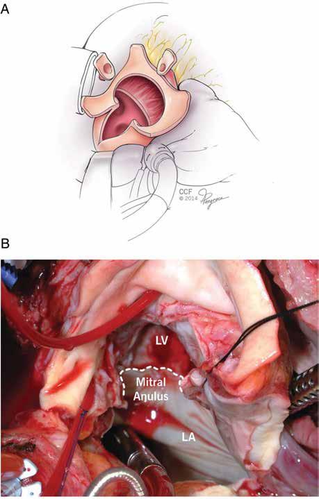 Double valve replacement and