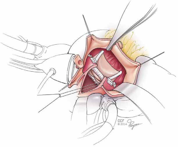 Double valve replacement and