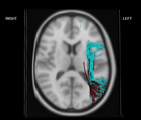 Nervbanor mellan hjärnans språk- och