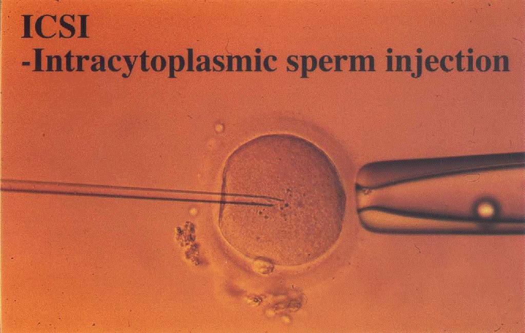 Intracytoplasmic sperm injection (ICSI) Palermo et al 1992 Indikation för ICSI