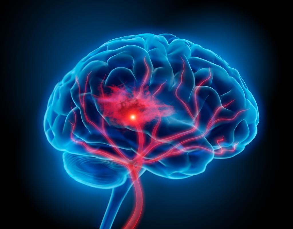 FAKTORER SOM PÅVERKAR RISKEN ATT AVLIDA EFTER EN STROKE En överlevnadsanalys med fokus på interaktion mellan kön och