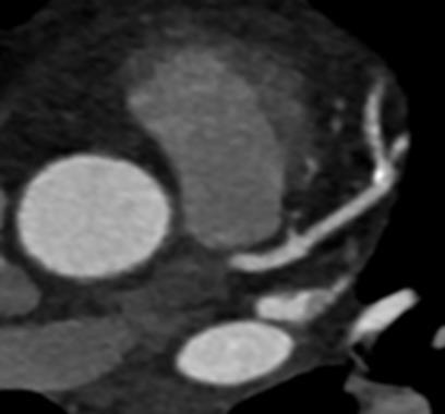 Infarction H eart failure