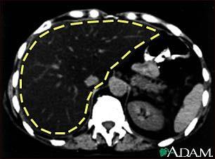 Atherosclerosis MI Stroke