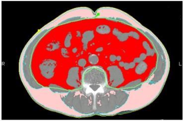 (CTA) Pericardial fat