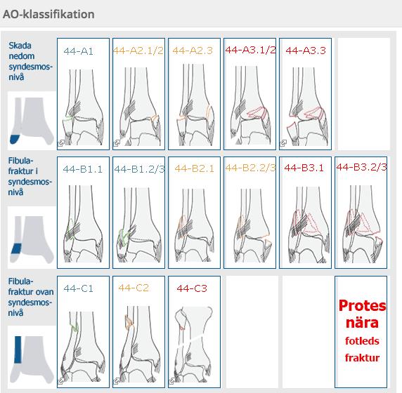 A1 Isolerad lateral malleolfraktur nedom ledspringenivå A2.1/2 Lateral ledbandsskada eller avulsionsfraktur nedom ledspringenivå och medial malleolfraktur A2.