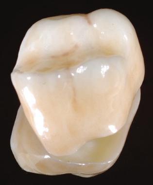 Prettau zirconia, Denzir eller BruxZir ) [1, 4]. Detta kräver mer plats för kronmaterialet och i regel betyder det att man måste ta bort mer tandsubstans.