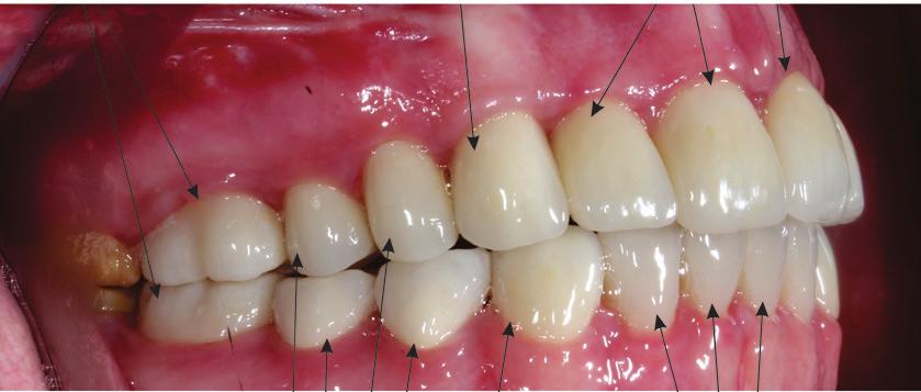 Figur IV. En patient med starkt destruerade tänder på grund av amelogenesis imperfecta har fått en restaurering med 24 enskilda kronor.