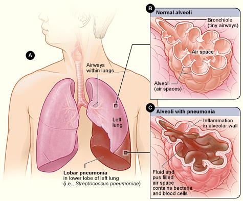 Bakgrunden Pneumoni definieras som en infektionsutlöst inflammation i lungvävnaden.